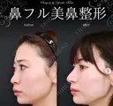鼻フル（隆鼻術プロテーゼ・鼻中隔延長術・鼻尖形成・鼻先軟骨移植・鼻柱軟骨移植） before画像 サムネイル用
