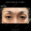 目の下の切らないクマ取り before画像 サムネイル用
