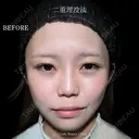 二重埋没法 before画像 サムネイル用