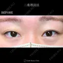 二重埋没法 before画像 サムネイル用