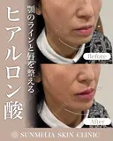 ヒアルロン酸 before画像 サムネイル用