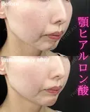 顎ヒアルロン酸 before画像 サムネイル用