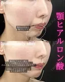 顎ヒアルロン酸 after画像 サムネイル用
