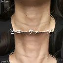 ヒローウェーブ(首のヒアルロン酸) before画像 サムネイル用