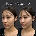 ヒローウェーブ（目の下・頬・こめかみ） after画像 サムネイル用