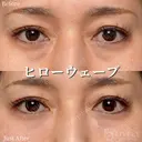 ヒローウェーブ（目の下） after画像 サムネイル用