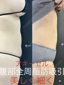 腹部全周脂肪吸引　アキ―セル使用 after画像 サムネイル用