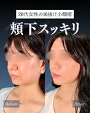 岩﨑先生による🔥小顔整形🔥 after画像 サムネイル用