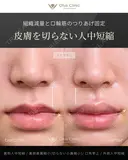 裏側人中短縮（口腔内人中短縮）・裏側鼻翼縮小（切らない鼻翼縮小）・口角挙上・外側人中短縮 90日後 サムネイル用