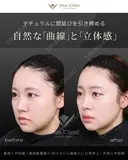 裏側人中短縮（口腔内人中短縮）・裏側鼻翼縮小（切らない鼻翼縮小）・口角挙上・外側人中短縮 before画像 サムネイル用