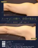【40代女性・スッキリ二の腕】ベイザー脂肪吸引 上腕（二の腕）（1ヶ月） 30日後 サムネイル用
