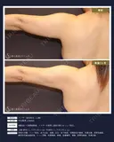 【40代女性・スッキリ二の腕】ベイザー脂肪吸引 上腕（二の腕）（1ヶ月） 30日後 サムネイル用