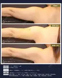 【40代女性・スッキリ二の腕】ベイザー脂肪吸引 上腕（二の腕）（1ヶ月） 30日後 サムネイル用
