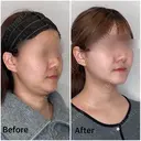 脂肪吸引（顔）＋糸リフト before画像 サムネイル用