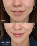 顎ヒアルロン酸 before画像 サムネイル用
