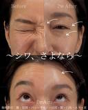 ボトックス after画像 サムネイル用