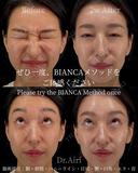 ボトックス after画像 サムネイル用