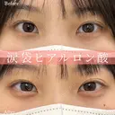 涙袋のヒアルロン酸注入 before画像 サムネイル用