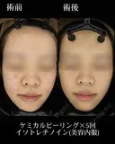 ケミカルピーリング/イソトレチノイン(美容内服) 300日後 サムネイル用