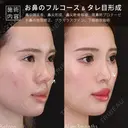 鼻中隔延長術・耳介軟骨移植・鼻尖形成・プロテーゼ・グラマラスライン切開術 before画像 サムネイル用