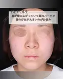 小鼻縮小 before画像 サムネイル用