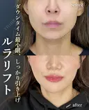 ルラリフト6本 after画像 サムネイル用