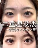 目元くっきり👀二重埋没 30日後 サムネイル用