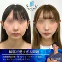 3D脂肪吸引（頬・顎下）/ジョールファット除去/メーラーファット除去/糸リフト after画像 サムネイル用