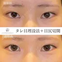 タレ目+目尻切開 14日後 サムネイル用