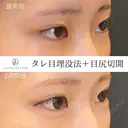 タレ目+目尻切開 14日後 サムネイル用