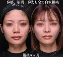 鼻筋、眉間、鼻先も全て自家組織 before画像 サムネイル用