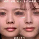鼻筋、眉間、鼻先も全て自家組織 180日後 サムネイル用