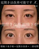 『眼瞼下垂手術は見開きを良くする手術です！』 before画像 サムネイル用