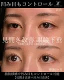 『眼瞼下垂手術は見開きを良くする手術です！』 90日後 サムネイル用