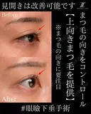 『眼瞼下垂手術は見開きを良くする手術です！』 90日後 サムネイル用