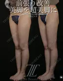 大腿全周・膝脂肪吸引 after画像 サムネイル用