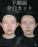 小顔フルコース after画像 サムネイル用
