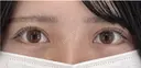 たるみ取り併用全切開二重術 after画像 サムネイル用