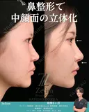 鼻整形　クローズ法の症例です。 after画像 サムネイル用