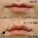 Cカールリップ（ジュビダーム） before画像 サムネイル用