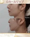 Cカールリップ before画像 サムネイル用