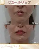 Cカールリップ after画像 サムネイル用