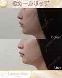 Cカールリップ before画像 サムネイル用