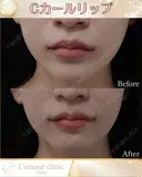 Cカールリップ after画像 サムネイル用
