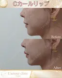 Cカールリップ before画像 サムネイル用