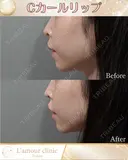 Cカールリップ before画像 サムネイル用