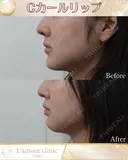 Cカールリップ before画像 サムネイル用