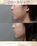 Cカールリップ before画像 サムネイル用