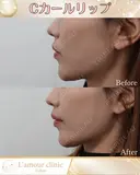 Cカールリップ before画像 サムネイル用