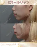 Cカールリップ before画像 サムネイル用